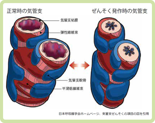 ぜんそく発作時の気管支