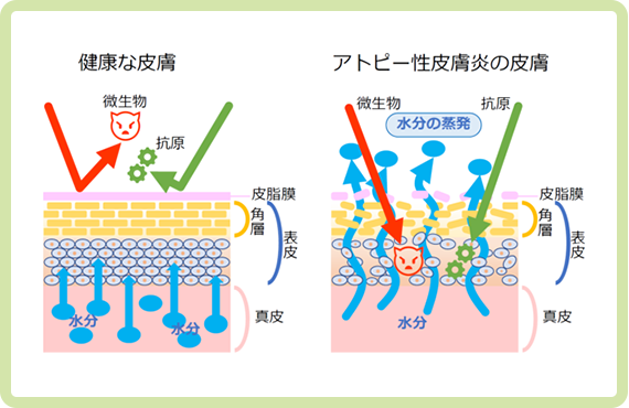 アトピー性皮膚炎図